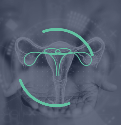 Pelvic congestion syndrome
